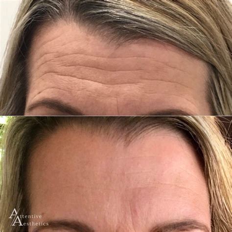 Wrinkle Relaxers Perth Anti Wrinkle Injections Perth Attentive