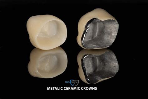 Fascina satisfacţie a picta metal ceramic teeth Sus casă De neînlocuit