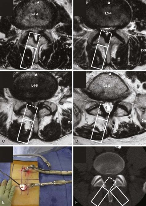 Minimally Invasive Posterior Approaches To The Spine Clinical Gate