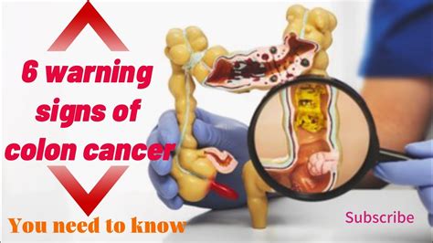 6 Warning Signs Of Colon Cancer Colon Cancer Symptoms Colon Cancer Youtube