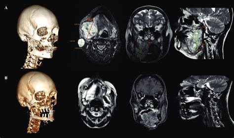 CT And MRI Reconstruction A The Tumor Of The Right Submandibular