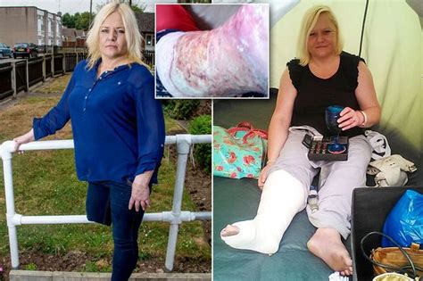 Mum Forced To Have Leg Amputated After She Cut It Shaving And Flesh