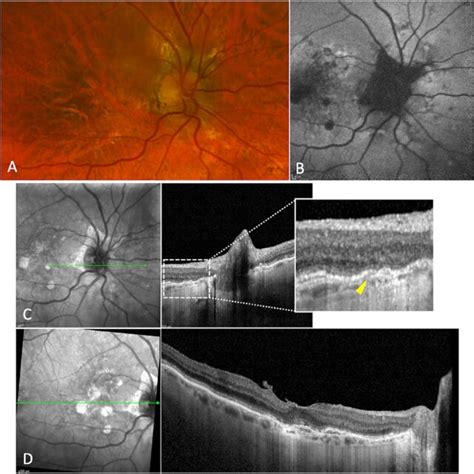 Multimodal Imaging Evaluation Of A Patient Affected By Intermediate AMD