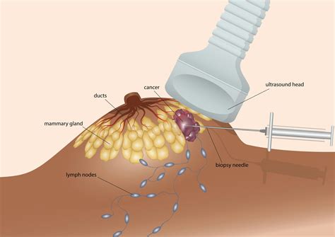 Biopsies Confirm A Breast Cancer Diagnosis After An Abnormal Mammogram But Structural Racism