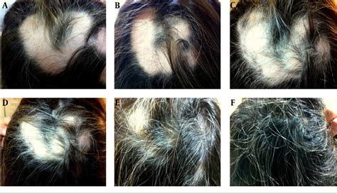 Figure 1 From Dystrophic Anagen Effluvium Occurring During Pegylated Interferon α 2a Ribavirin