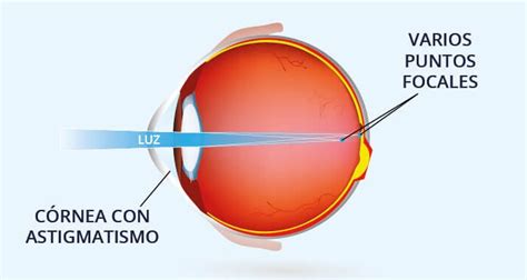 Astigmatismo Qu Es Y C Mo Se Trata Cl Nica Baviera Atelier Yuwa