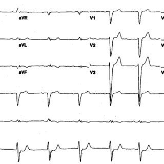 Twelve Lead Electrocardiogram Ecg Of A Wide Qrs Complex Tachycardia