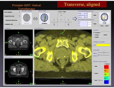 Adaptive Radiation Therapy With Tomo Therapy