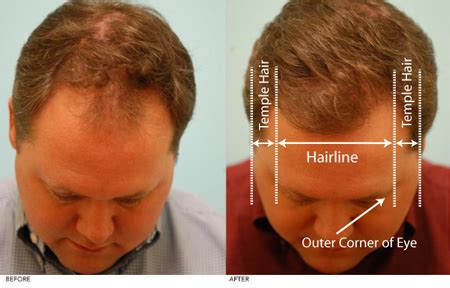 Perfect Hairline Technique