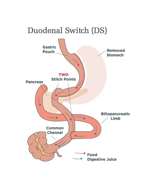 Duodenal Switch Procedures Sadi S And Classic Ds Ut Health Tyler