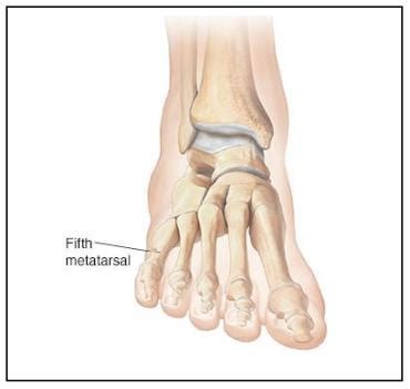 Base Of 5th Metatarsal Fracture University Hospitals Sussex NHS