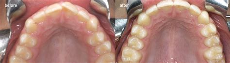 Ca® Clear Aligner