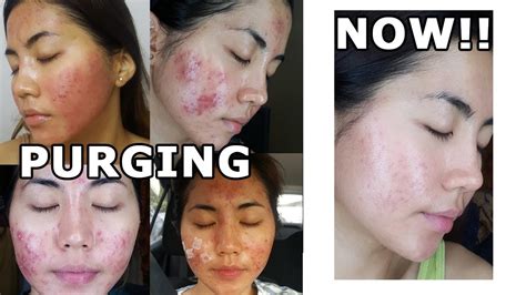 Acne Skincare And Treatment Youtube