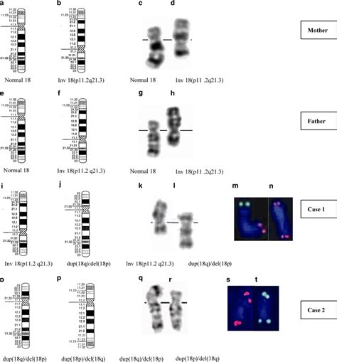 Idiograms Of Chromosome 18 A B E F I J O P Representative Download Scientific Diagram