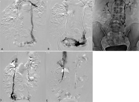 A Renal Venography Demonstrating Ovarian Vein Reflux Into A Dilated