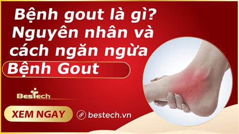 Bệnh Gout Là Gì Nguyên Nhân Và Cách Ngăn Ngừa Bệnh Gout Ghế Massage