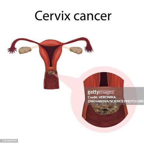 Cervical Cancer Illustration Photos And Premium High Res Pictures