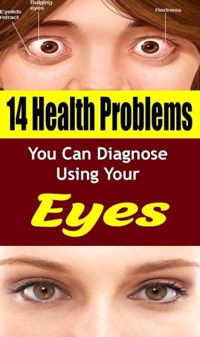 14 Health Problems You Can Diagnose Using Your Eyes Ijok Marina Medium