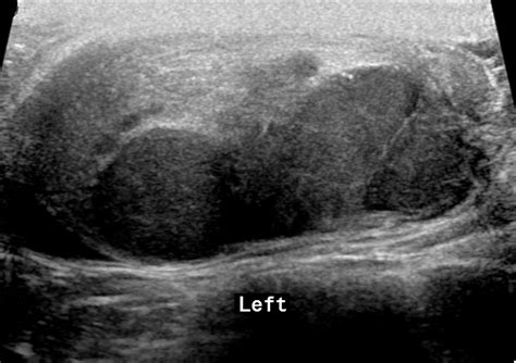 Testicular Seminoma Image