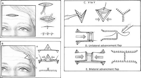 Concepts In Local Flap Design And Classification Operative Techniques