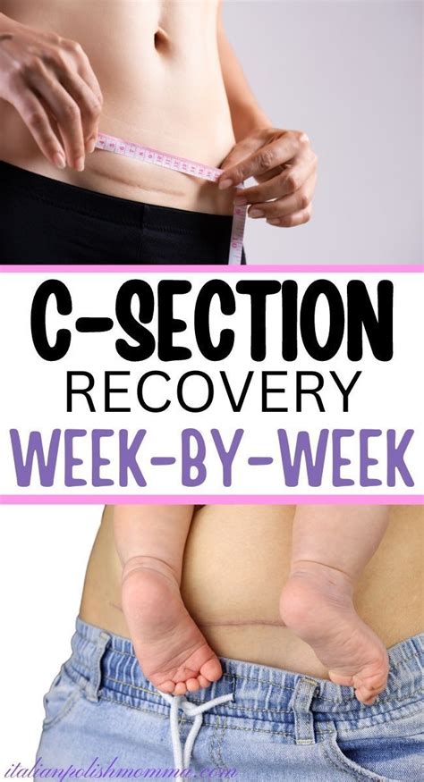 C Section Recovery Timeline Artofit