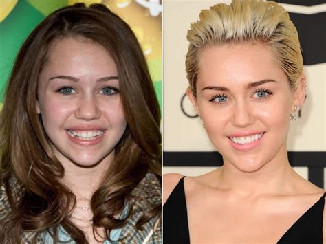 Miley Cyrus' Teeth - Smile Team Turkey