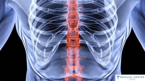 Spinal Fusion Cost In Turkey MCT