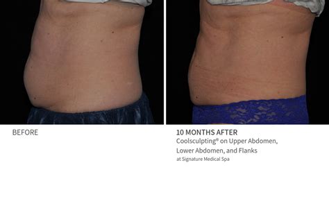 Body Sculpting Before & After Results | Med Spa | Charlottesville, VA