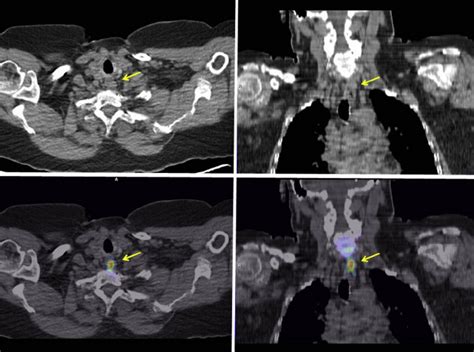 Methioninepositron Emission Tomography Computed Tomography Showing An