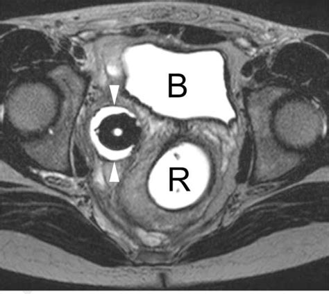 Figure 2 From Mr Imaging In Patients With Male To Female Sex