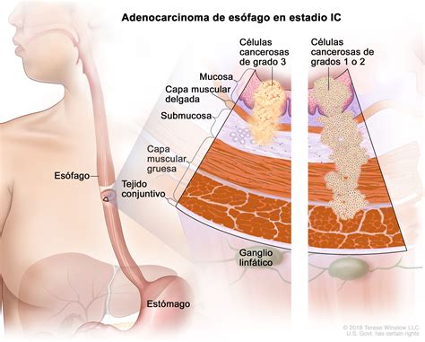 Tratamiento del cáncer de esófago en adultos PDQ Versión para