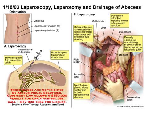 AMICUS Illustration Of Amicus Surgery Injury Laparoscopy Laparotomy