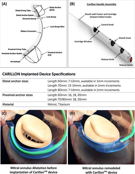 Transcatheter Mitral Valve Repair An Overview Of Current And Future