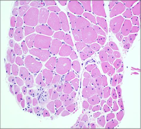 This H and E stained skeletal muscle with perifascicular atrophy and ...