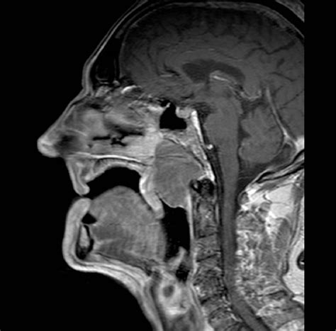 Figure 3 From Imaging Of Lymphomas Of The Head And Neck Semantic Scholar