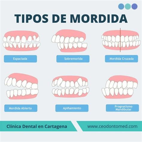 Qu Es La Maloclusi N Y C Mo Se Puede Tratar Ceodontomed