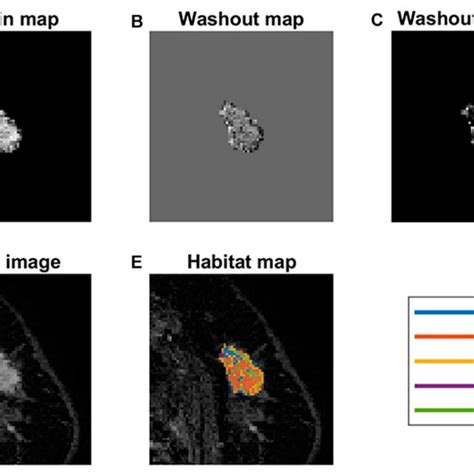 Mri Of A 51 Year Old Woman With Invasive Ductal Carcinoma In The Left