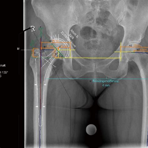 Digital Planning Of Cup And Stem For Total Hip Arthroplasty Of The