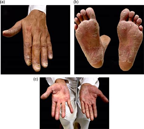 Ac Palmoplantar Pustulosis With Severe Involvement Of The Nail Units