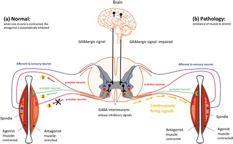 Reciprocal Inhibition And Stiffness Generation In Stiff Person Syndrome