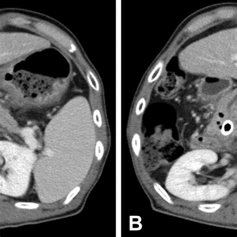 Abdominal Ct Reveals A Main Pancreatic Duct Stricture In The Head Of Download Scientific