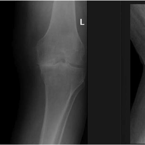 Preoperative Plain Radiographs Standing Posteroanterior And Lateral