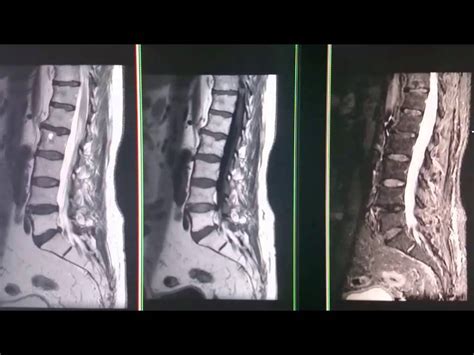 Resonancia Magnetica De Columna Lumbar Y Columna Dorsal Youtube