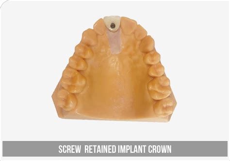 Screw Retained Implant Crown Solutions Dental Lab