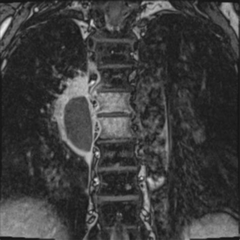 Thoracic Paravertebral Abscess And Osteomyelitis Image Radiopaedia Org