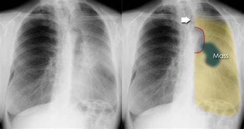 Atelectasis Chest X Ray