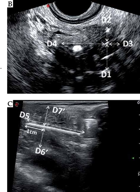 Figure 2 From Application Of Transrectal Ultrasound In Guiding Interstitial Brachytherapy For