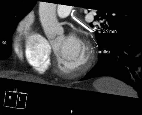 Angiographic Efficacy Of The Atriclip Left Atrial Appendage Exclusion