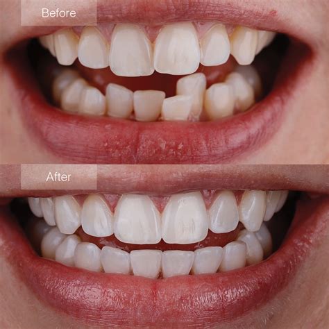 Invisalign Before And After Spacing