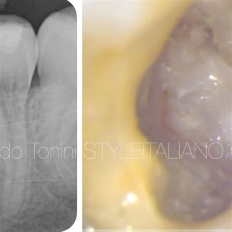 Endodontic treatment of an immature necrotic tooth - Style Italiano Endodontics